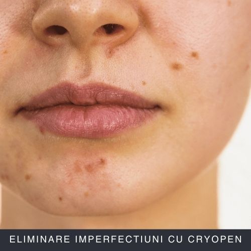Eliminare imperfectiuni cu CryoPen Curs Online Eliminare imperfectiuni cu CryoPen Curs Online
